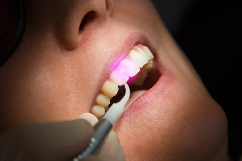 laser dentistry best dentist Wichita
